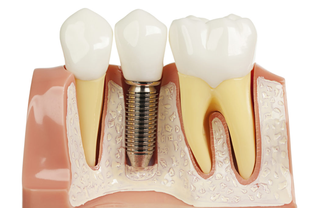 Implantes Dentários